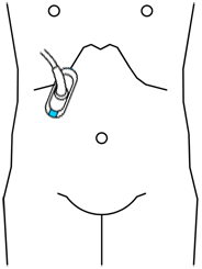 rez_transhepatalni