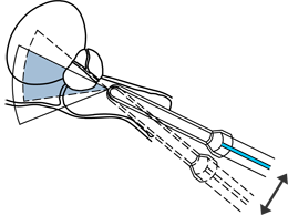 naklapeni