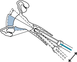 naklapeni
