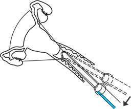 naklapeni