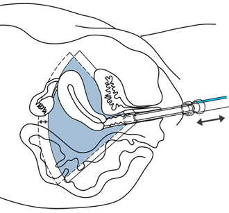 zasouvani